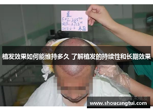 植发效果如何能维持多久 了解植发的持续性和长期效果